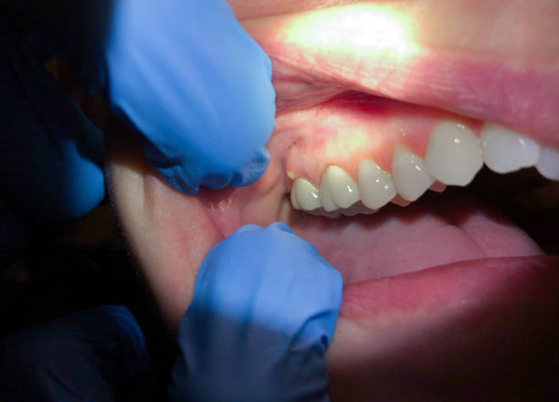 Best Emergency Dental Services for Seniors in North Terre Haute, IN