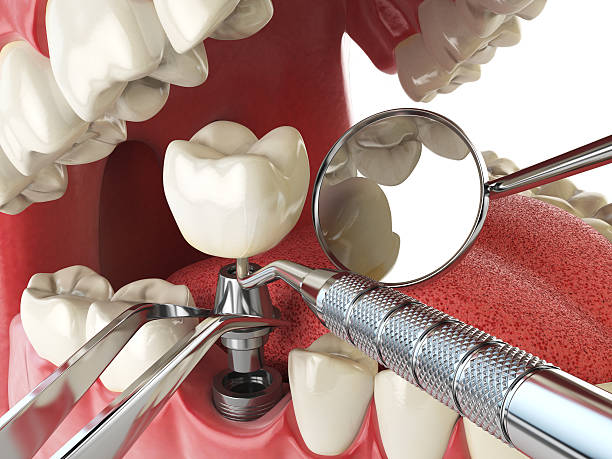 Best Emergency Dentist for Lost Fillings or Crowns in North Terre Haute, IN